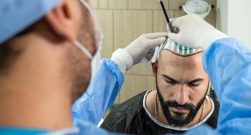 Top 10 Hair Transplant Clinics in Turkey
